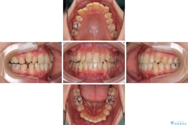 上下の八重歯を治したい　インビザラインと補助装置を用いた抜歯治療 治療途中画像