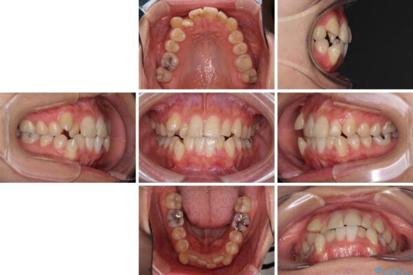 上下の八重歯を治したい　インビザラインと補助装置を用いた抜歯治療 治療前画像