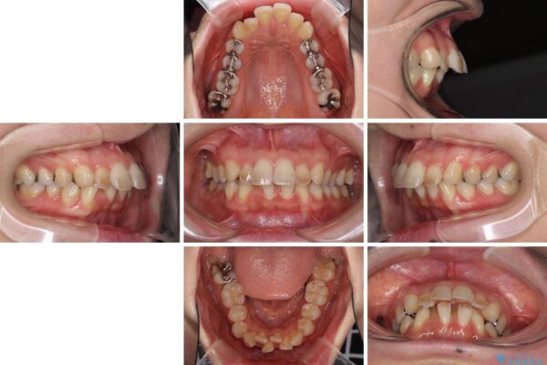 閉じにくい口元　前歯を引っ込める抜歯矯正 治療前画像