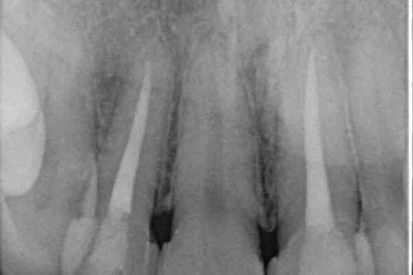 欠けてしまった前歯のセラミック　同じ色合いで再製作 治療前画像