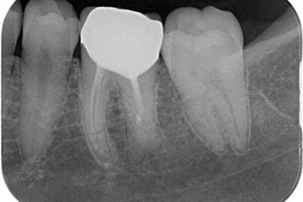 形が気に入らない　奥歯のオールセラミッククラウン 治療後画像