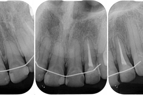 矯正しても虫歯が気になる　前歯のオールセラミッククラウン 治療前画像