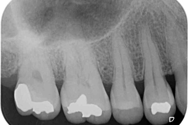 奥歯の虫歯　ゴールドインレーによる修復治療 治療後画像