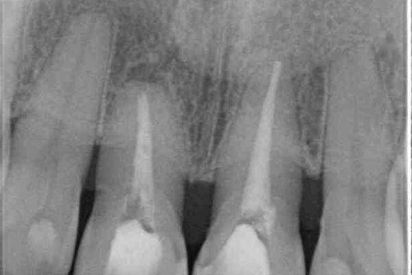 部分矯正とセラミック　前歯の審美治療 治療前画像