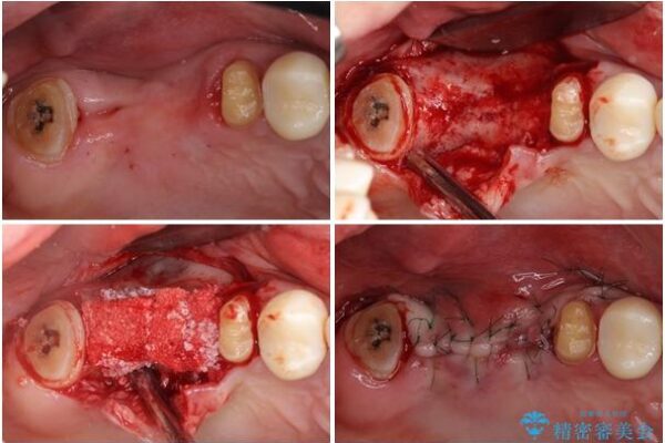 歯周病改善のための総合歯科治療 治療途中画像