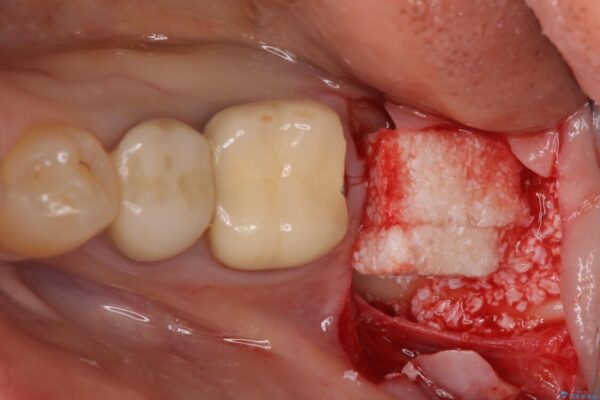 痛みを感じる奥歯　根管治療とインプラント治療 治療後画像