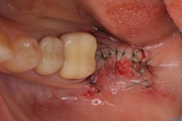 痛みを感じる奥歯　根管治療とインプラント治療 治療前画像