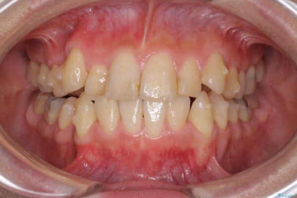 上下の八重歯を治したい　インビザラインと補助装置を用いた抜歯治療 治療途中画像