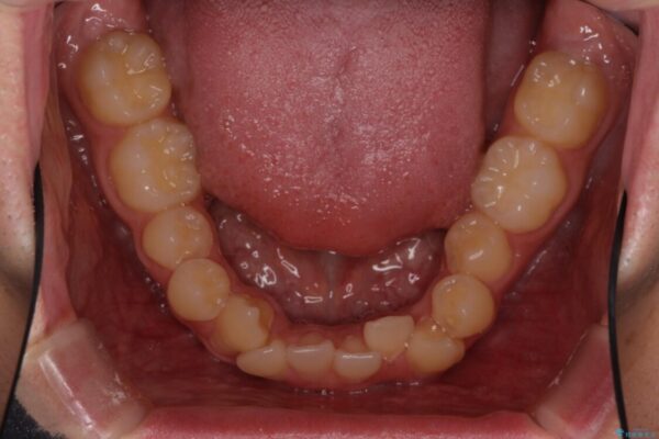 八重歯を治したい　目立たないワイヤー装置での抜歯矯正 治療前画像