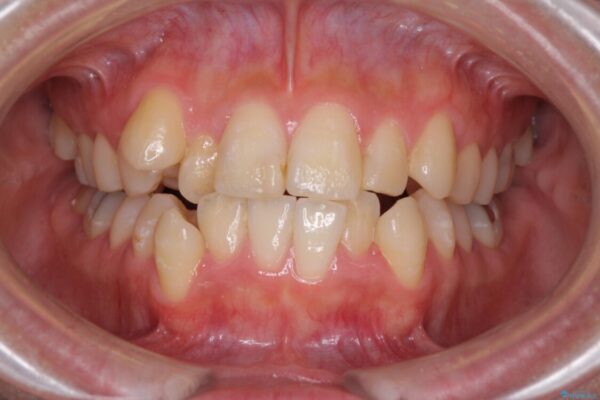 上下の八重歯を治したい　インビザラインと補助装置を用いた抜歯治療 ビフォー