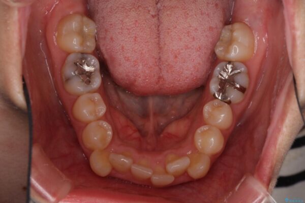 上下の八重歯を治したい　インビザラインと補助装置を用いた抜歯治療 治療前画像