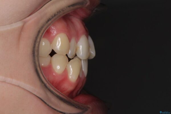 前歯のクロスバイトを治したい　インビザラインによる矯正治療 治療前画像