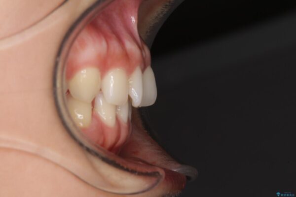 隙間だらけの歯列をきれいに　インビザライン矯正とセラミック補綴治療 治療前画像