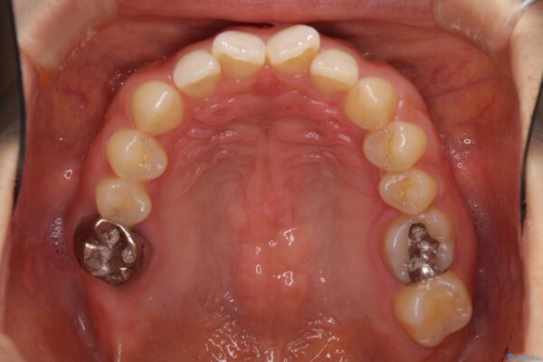 隙間だらけの歯列をきれいに　インビザライン矯正とセラミック補綴治療 治療前画像