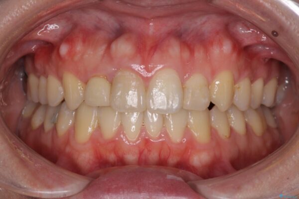 狭い上顎骨を拡大　インビザラインによる非抜歯矯正 アフター