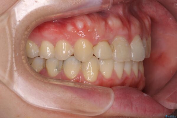狭い上顎骨を拡大　インビザラインによる非抜歯矯正 治療後画像