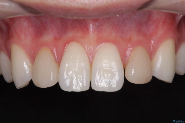ラミネートの前歯をオールセラミッククラウンで自然に 治療前画像
