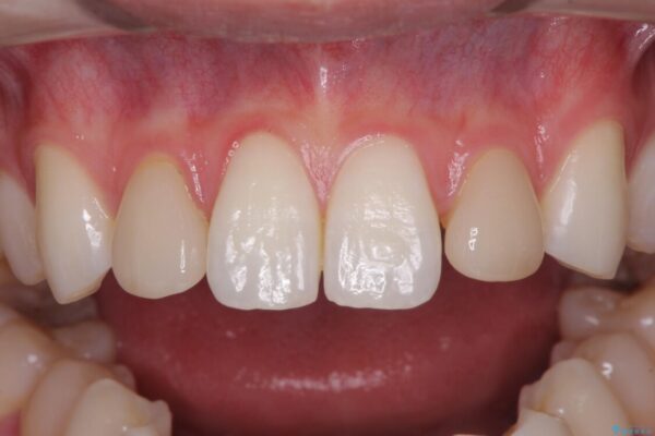 ラミネートの前歯をオールセラミッククラウンで自然に 治療前画像