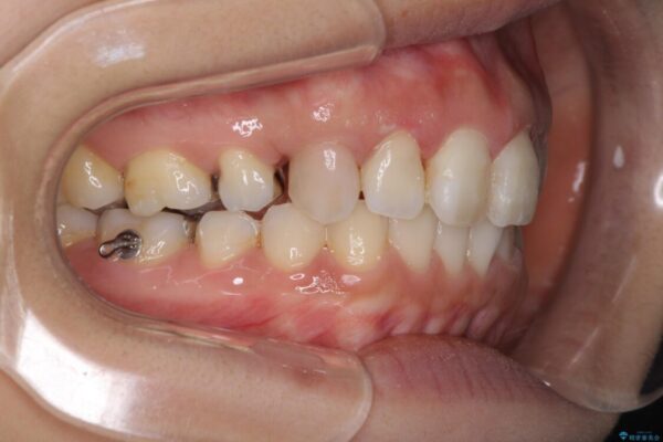 前歯の突出を軽減　インビザラインによる抜歯矯正 治療途中画像