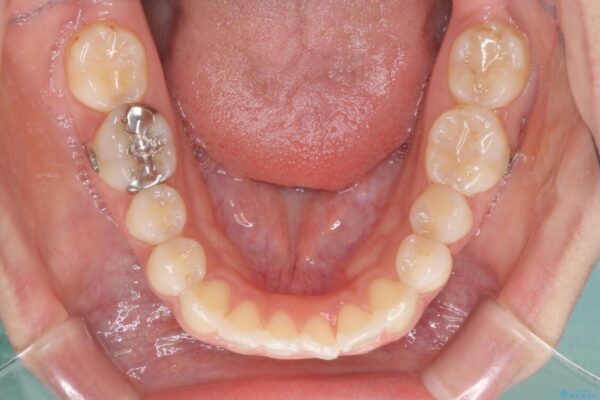 前歯の突出を軽減　インビザラインによる抜歯矯正 治療途中画像