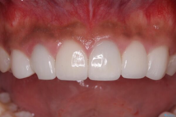 欠けてしまった前歯のセラミック　同じ色合いで再製作 治療前画像