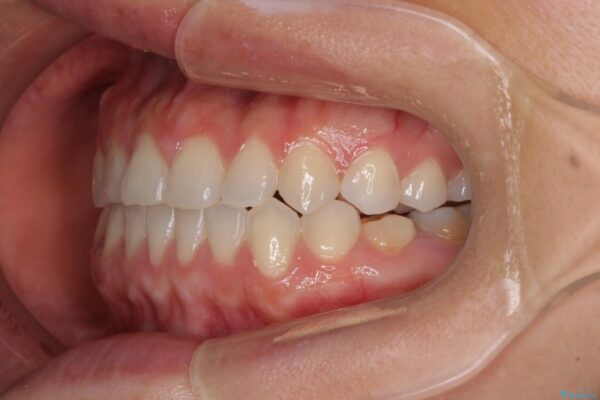 隙間の空いた前歯を治したい　インビザライン矯正治療 治療後画像