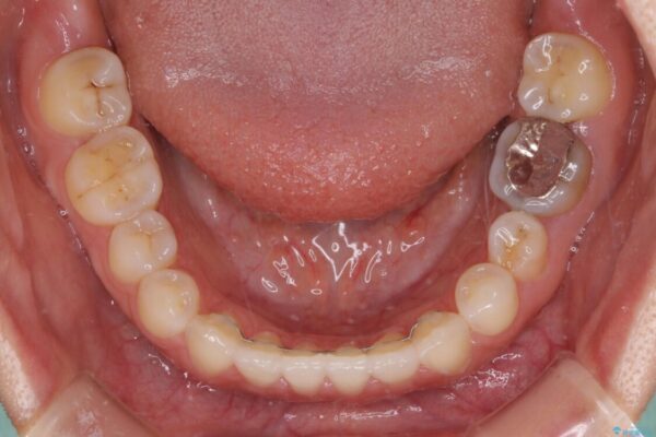 隙間の空いた前歯を治したい　インビザライン矯正治療 治療後画像