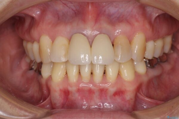 部分矯正とセラミック　前歯の審美治療 アフター