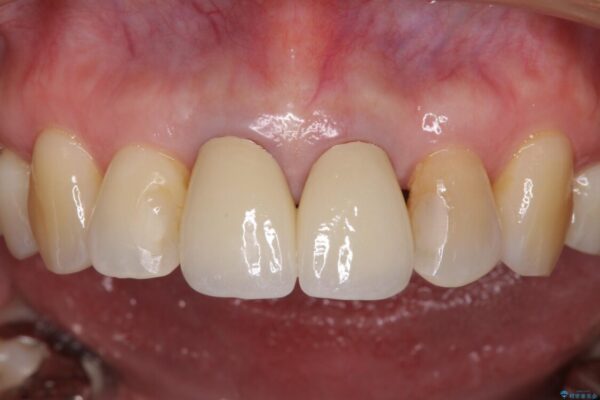 部分矯正とセラミック　前歯の審美治療 治療後画像
