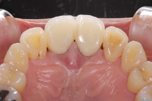 部分矯正とセラミック　前歯の審美治療 治療後画像