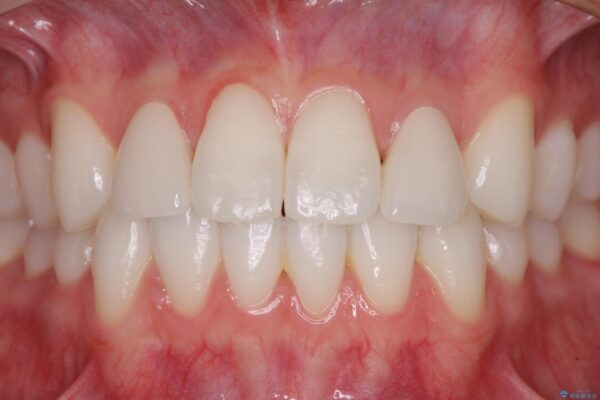 ラミネートの前歯をオールセラミッククラウンで自然に 治療後画像