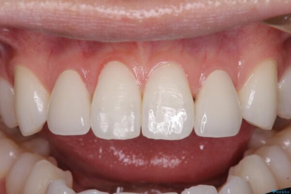 ラミネートの前歯をオールセラミッククラウンで自然に 治療後画像