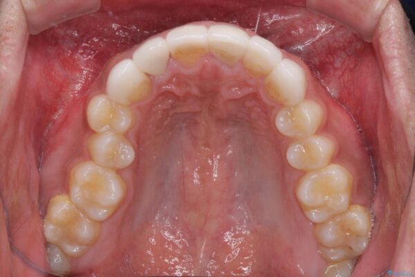 欠けてしまった前歯のセラミック　同じ色合いで再製作 治療後画像