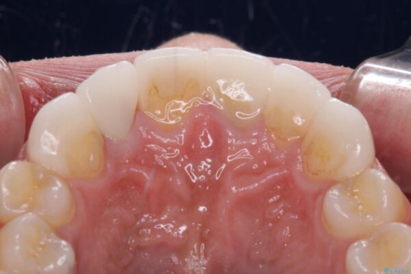 欠けてしまった前歯のセラミック　同じ色合いで再製作 治療後画像