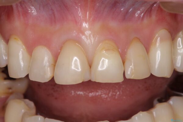 矯正しても虫歯が気になる　前歯のオールセラミッククラウン 治療前画像