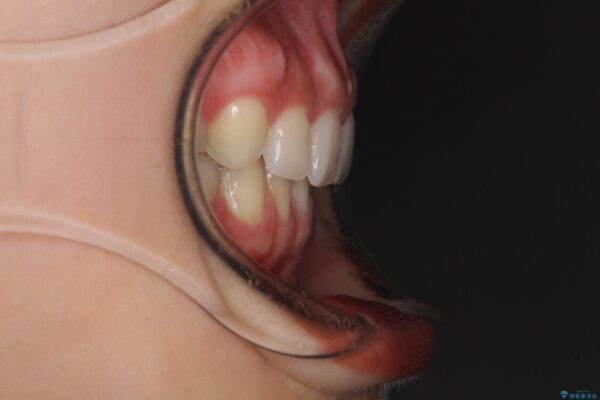 隙間だらけの歯列をきれいに　インビザライン矯正とセラミック補綴治療 治療後画像