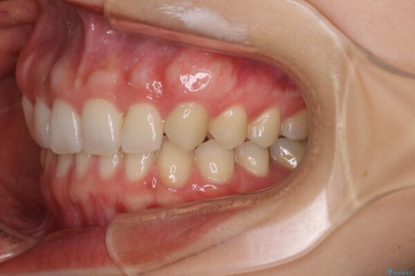 隙間だらけの歯列をきれいに　インビザライン矯正とセラミック補綴治療 治療後画像