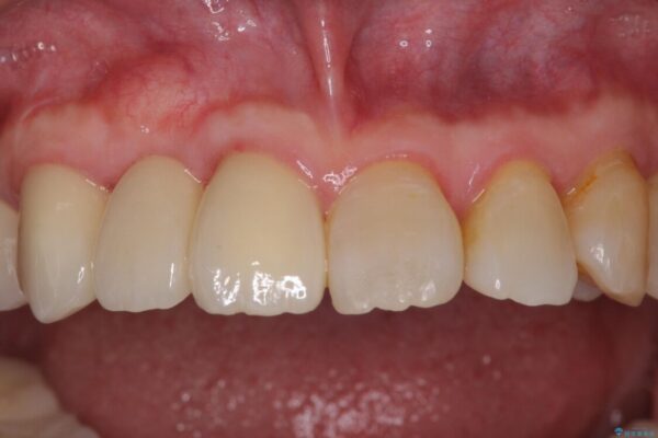 歯周病改善のための総合歯科治療 治療後画像