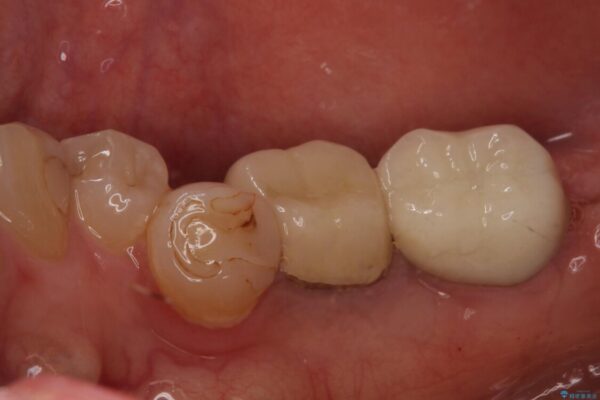 痛みを感じる奥歯　根管治療とインプラント治療 治療後画像