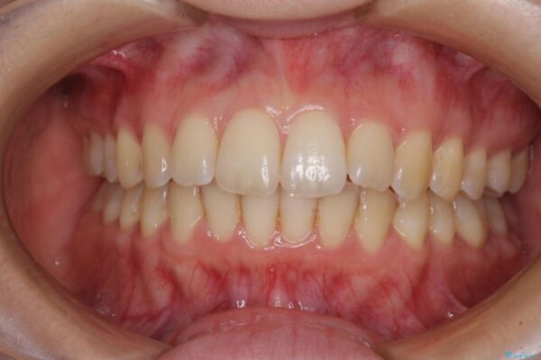 前歯のデコボコを解消　インビザラインによる矯正治療 治療後画像