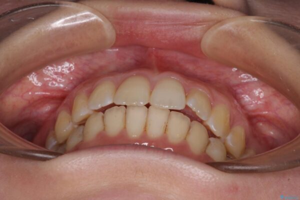 前歯のデコボコを解消　インビザラインによる矯正治療 治療後画像