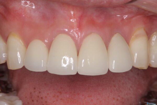 矯正しても虫歯が気になる　前歯のオールセラミッククラウン 治療後画像