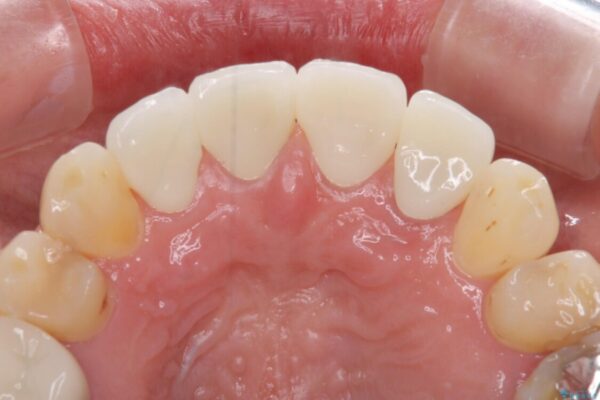 矯正しても虫歯が気になる　前歯のオールセラミッククラウン 治療後画像