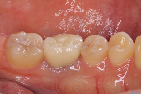 形が気に入らない　奥歯のオールセラミッククラウン 治療後画像