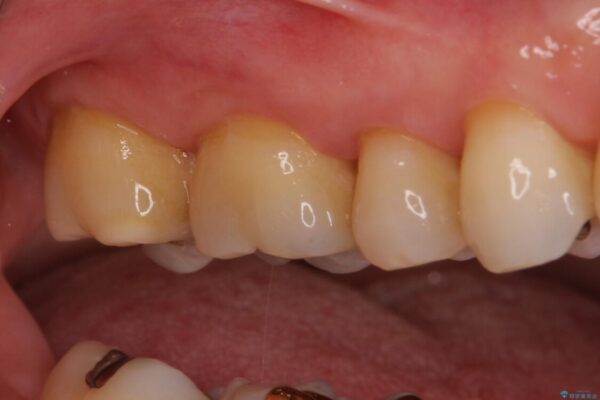 奥歯の虫歯　ゴールドインレーによる修復治療 治療後画像