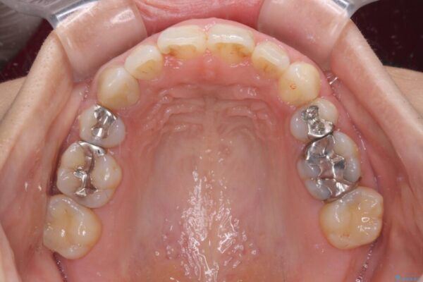 前歯の突出を軽減　インビザラインによる抜歯矯正 治療後画像
