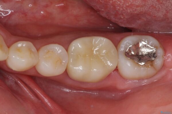 奥歯の虫歯　オールセラミッククラウンによる補綴治療 治療後画像