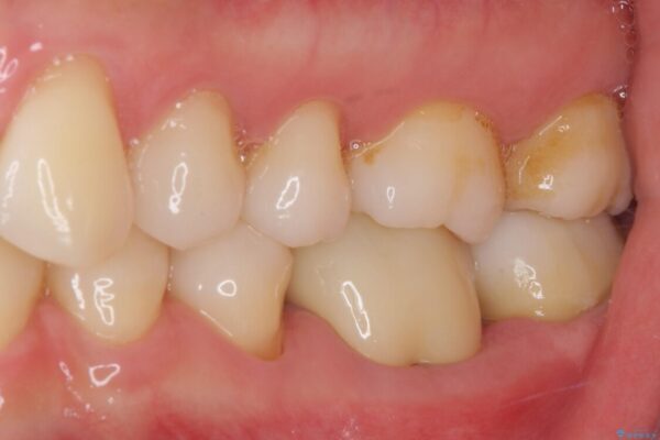 奥歯の虫歯　オールセラミッククラウンによる補綴治療 治療後画像