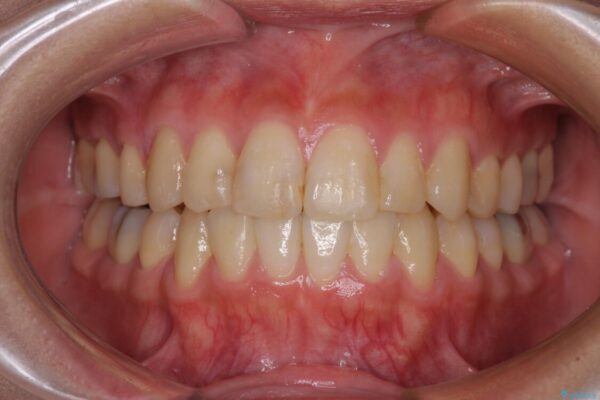 上下の八重歯を治したい　インビザラインと補助装置を用いた抜歯治療 アフター