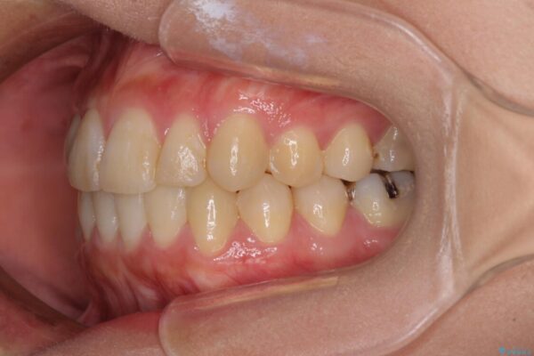 上下の八重歯を治したい　インビザラインと補助装置を用いた抜歯治療 治療後画像